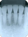歯肉炎のレントゲン像